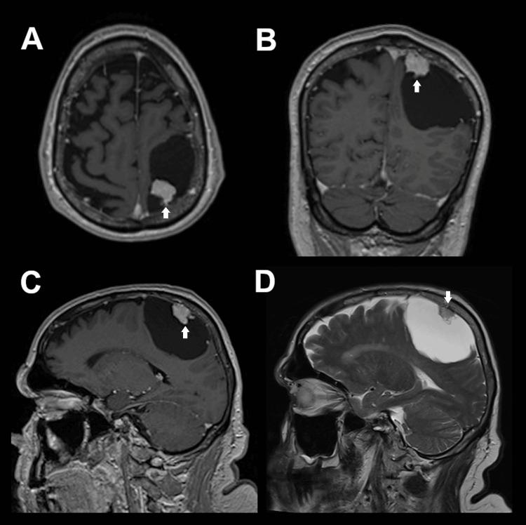 https://cdn.ncbi.nlm.nih.gov/pmc/blobs/7aa0/12233036/b405ad1bd378/cureus-0017-00000085513-i01.jpg