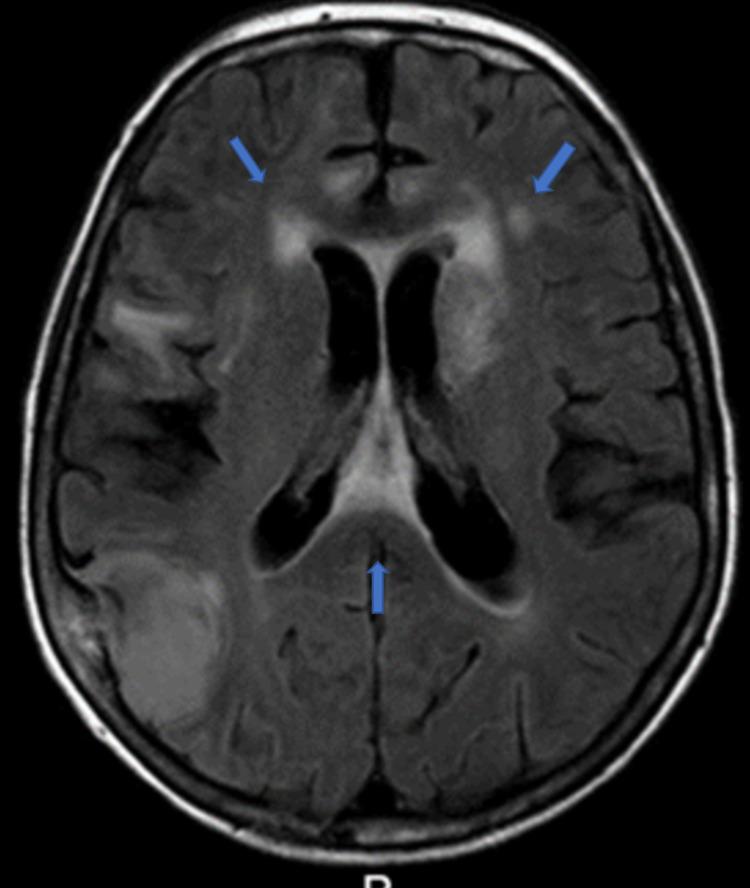https://cdn.ncbi.nlm.nih.gov/pmc/blobs/7aea/9851570/1fb53af9d096/cureus-0014-00000032747-i02.jpg