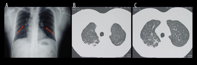https://cdn.ncbi.nlm.nih.gov/pmc/blobs/7b19/5391803/379beebdafa0/amjcaserep-18-367-g004.jpg