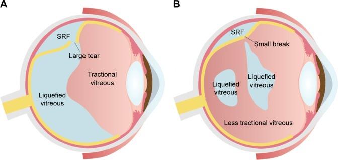 https://cdn.ncbi.nlm.nih.gov/pmc/blobs/7b4d/6124476/20018af118b1/opth-12-1605Fig1.jpg