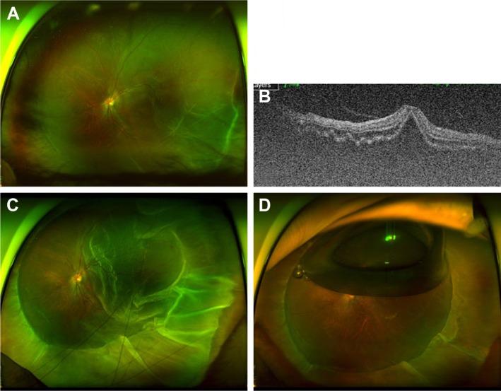 https://cdn.ncbi.nlm.nih.gov/pmc/blobs/7b4d/6124476/32bc8f432e5e/opth-12-1605Fig6.jpg