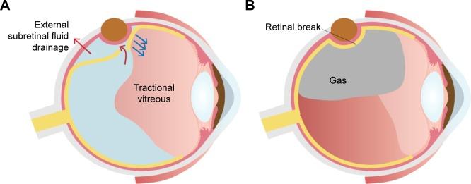 https://cdn.ncbi.nlm.nih.gov/pmc/blobs/7b4d/6124476/9967aa36948c/opth-12-1605Fig5.jpg