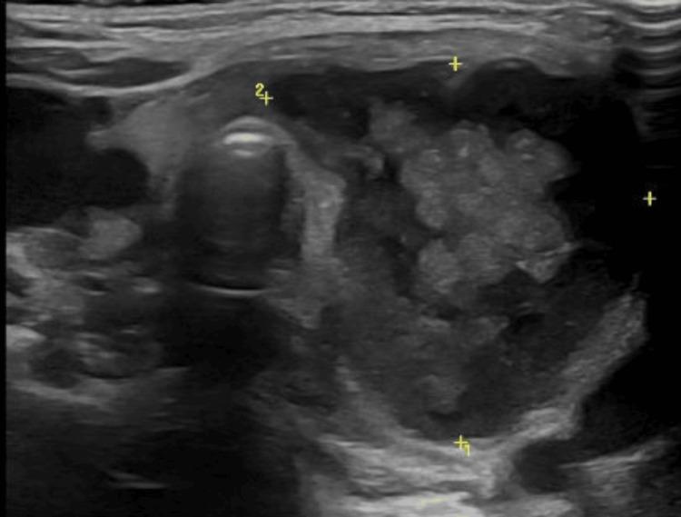 https://cdn.ncbi.nlm.nih.gov/pmc/blobs/7b5d/10982137/39b1f0788bf0/cureus-0016-00000055275-i01.jpg