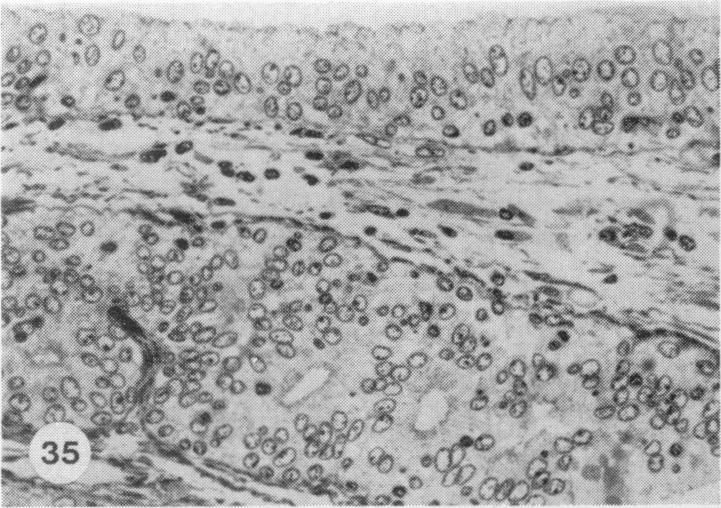 https://cdn.ncbi.nlm.nih.gov/pmc/blobs/7b6f/2041687/d731d264a827/brjexppathol00111-0033-c.jpg