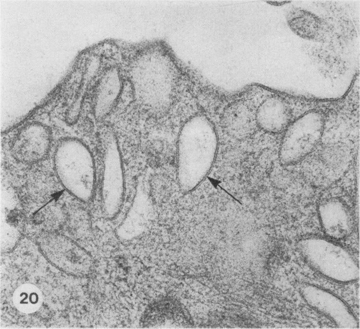 https://cdn.ncbi.nlm.nih.gov/pmc/blobs/7b6f/2041687/f6cd07ad58a5/brjexppathol00111-0027-c.jpg