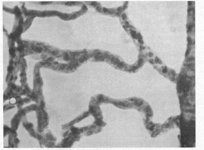 https://cdn.ncbi.nlm.nih.gov/pmc/blobs/7b81/505844/04e32c2f2ba4/brjopthal00405-0015-a.jpg
