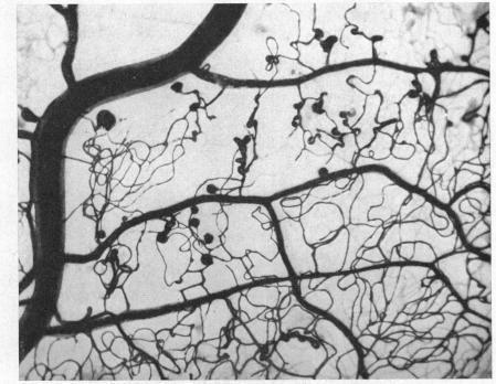 https://cdn.ncbi.nlm.nih.gov/pmc/blobs/7b81/505844/1bd72796d68c/brjopthal00405-0021-a.jpg