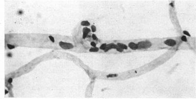 https://cdn.ncbi.nlm.nih.gov/pmc/blobs/7b81/505844/861b876e0e50/brjopthal00405-0018-b.jpg