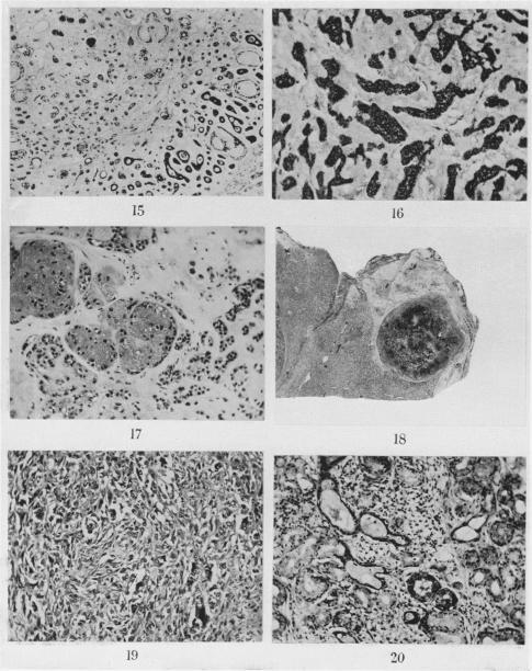 https://cdn.ncbi.nlm.nih.gov/pmc/blobs/7b82/2074185/1c0d27cf9de9/brjcancer00365-0033-a.jpg