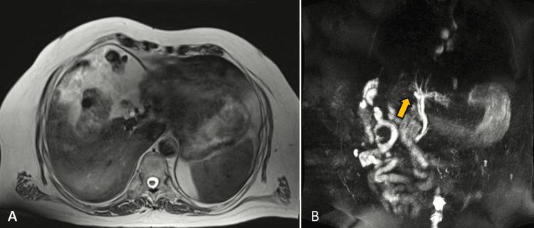 https://cdn.ncbi.nlm.nih.gov/pmc/blobs/7b8b/10807820/d5d8150a884a/cureus-0015-00000051078-i01.jpg