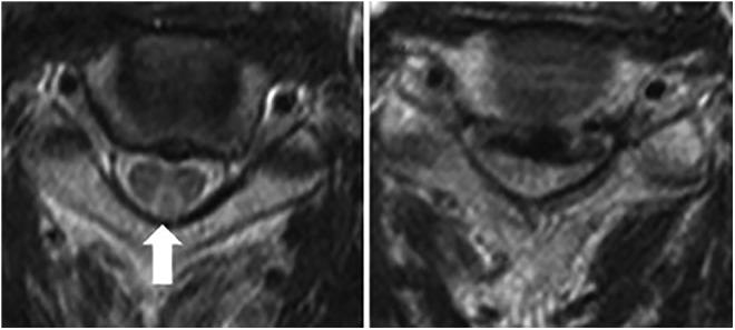 https://cdn.ncbi.nlm.nih.gov/pmc/blobs/7bb0/6542160/d93edcd3ea0b/10.1177_2192568218758633-fig2.jpg