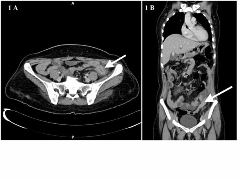 https://cdn.ncbi.nlm.nih.gov/pmc/blobs/7bd6/7779172/3981f845fb76/cureus-0012-00000011809-i01.jpg