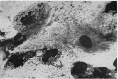 https://cdn.ncbi.nlm.nih.gov/pmc/blobs/7be7/480554/79adf7aee208/jclinpath00074-0069-c.jpg