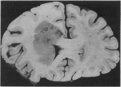 https://cdn.ncbi.nlm.nih.gov/pmc/blobs/7bfd/502577/7b8c2018a407/jclinpath00397-0021-e.jpg