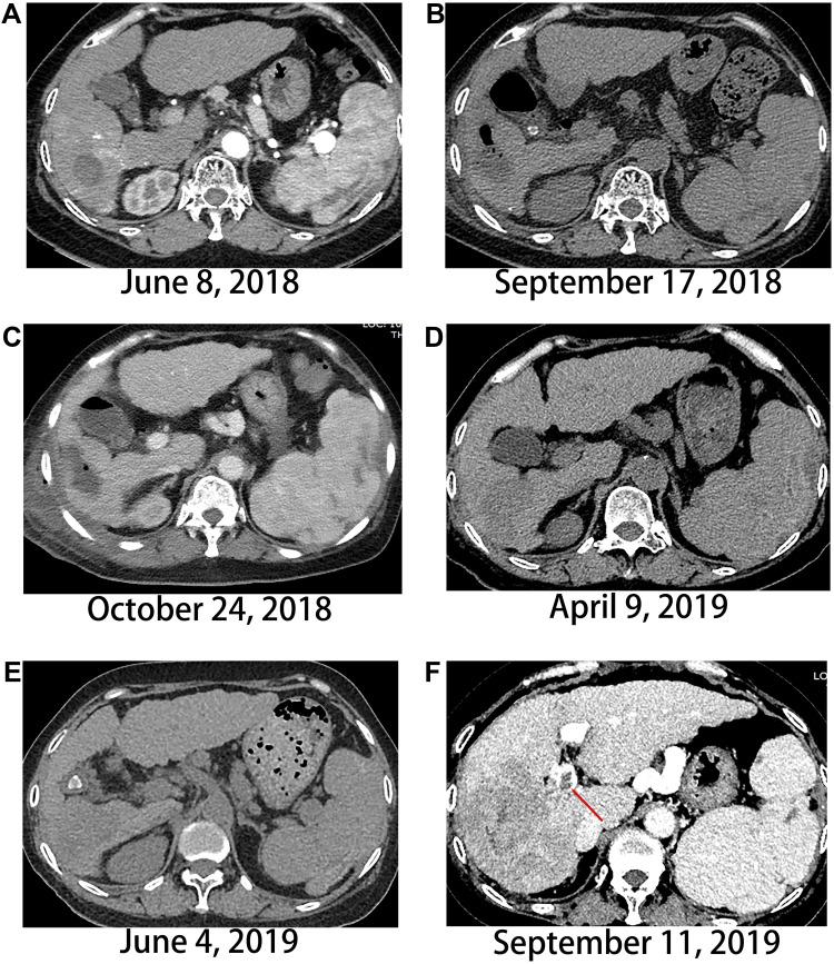 https://cdn.ncbi.nlm.nih.gov/pmc/blobs/7bfd/9250789/6e6843146e0a/OTT-15-703-g0004.jpg
