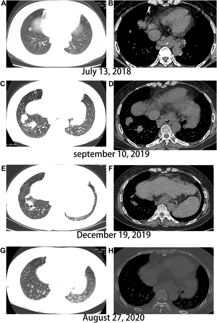 https://cdn.ncbi.nlm.nih.gov/pmc/blobs/7bfd/9250789/a9d1e3b04815/OTT-15-703-g0003.jpg
