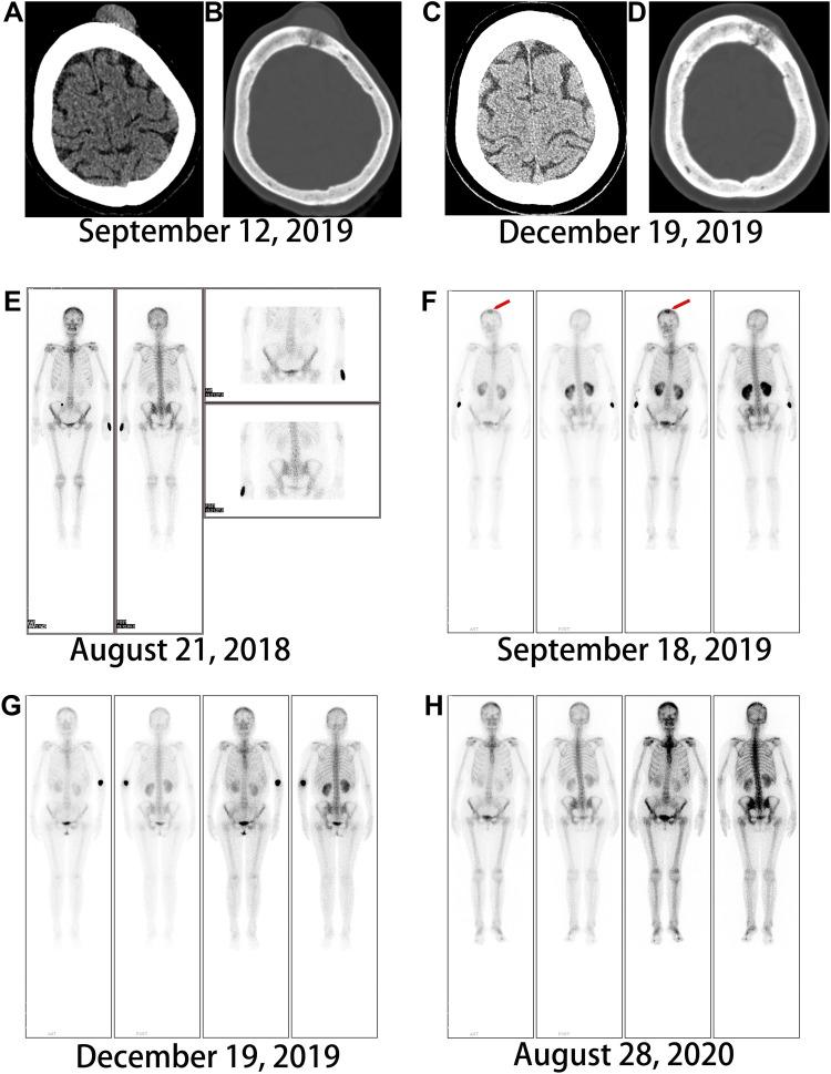 https://cdn.ncbi.nlm.nih.gov/pmc/blobs/7bfd/9250789/d66c50697fbb/OTT-15-703-g0005.jpg