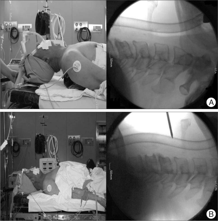 https://cdn.ncbi.nlm.nih.gov/pmc/blobs/7c53/3539079/7ac6d64ef789/jkns-52-452-g001.jpg