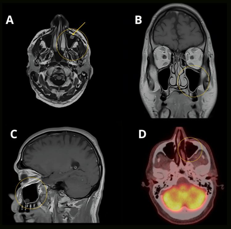 https://cdn.ncbi.nlm.nih.gov/pmc/blobs/7cb0/12266735/74896abed4a2/cureus-0017-00000086153-i03.jpg