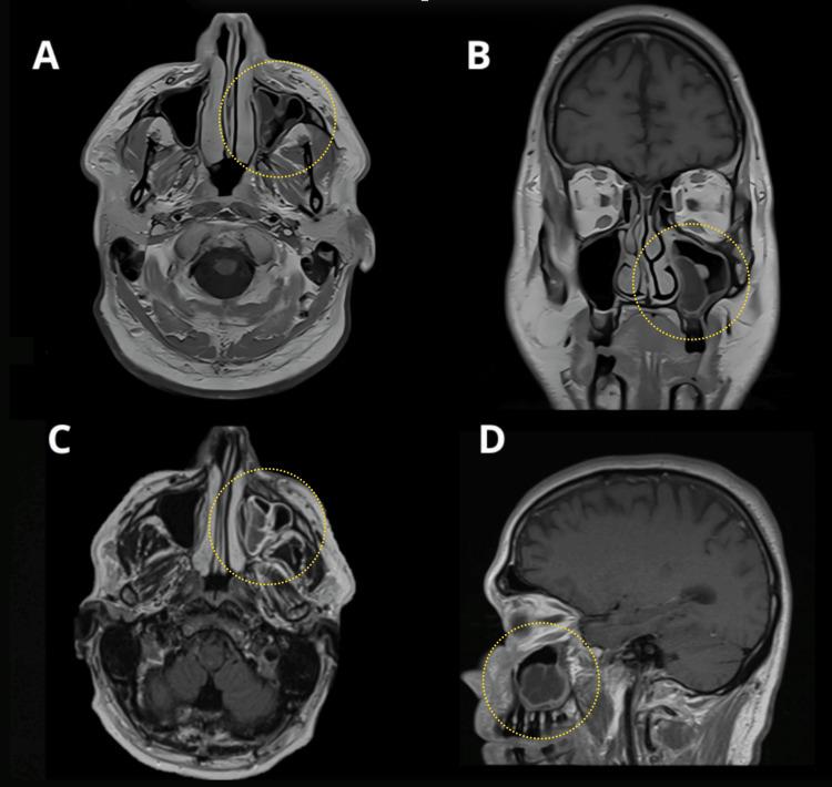 https://cdn.ncbi.nlm.nih.gov/pmc/blobs/7cb0/12266735/f257a1ca11b7/cureus-0017-00000086153-i01.jpg