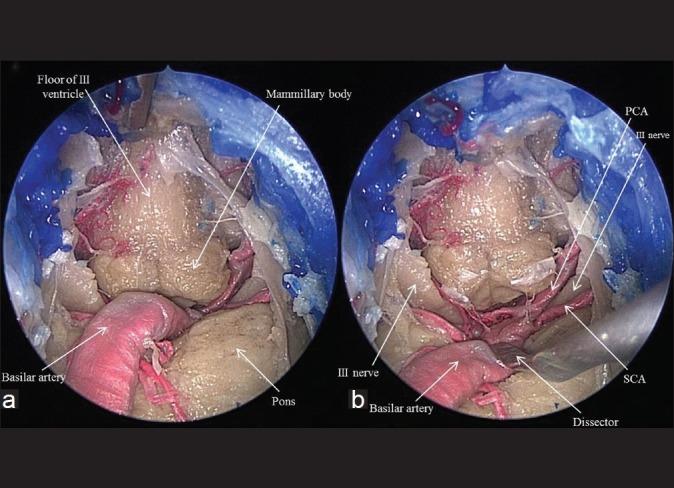 https://cdn.ncbi.nlm.nih.gov/pmc/blobs/7cf5/3385065/cfa683a7366b/SNI-3-64-g004.jpg