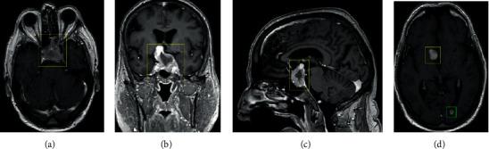 https://cdn.ncbi.nlm.nih.gov/pmc/blobs/7d02/7391092/6221d69d7c31/CRIONM2020-5073236.002.jpg
