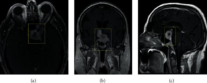 https://cdn.ncbi.nlm.nih.gov/pmc/blobs/7d02/7391092/d943c9b7f8b3/CRIONM2020-5073236.001.jpg