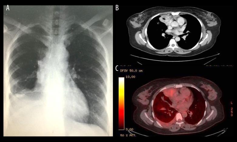 https://cdn.ncbi.nlm.nih.gov/pmc/blobs/7d39/5865406/3eb709c419b8/amjcaserep-19-267-g001.jpg