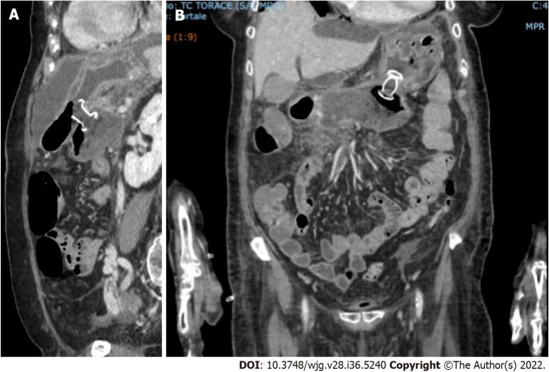 https://cdn.ncbi.nlm.nih.gov/pmc/blobs/7d4f/9521525/936ccfd145d3/WJG-28-5240-g003.jpg