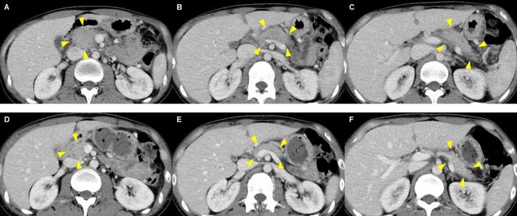 https://cdn.ncbi.nlm.nih.gov/pmc/blobs/7d58/12123552/bcac85516c5a/cureus-0017-00000083238-i01.jpg