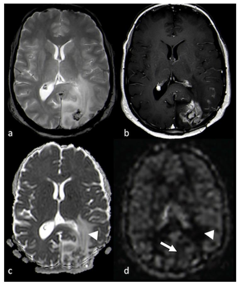 https://cdn.ncbi.nlm.nih.gov/pmc/blobs/7d9f/10252005/e6bdcceedf0f/cancers-15-02992-g009.jpg