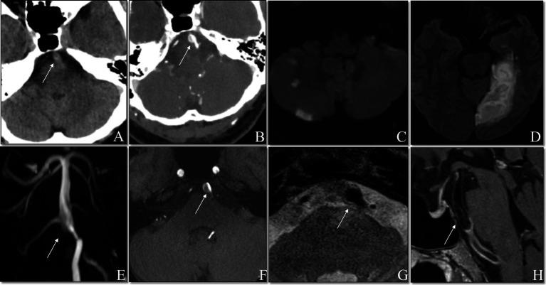 https://cdn.ncbi.nlm.nih.gov/pmc/blobs/7de7/12074948/c0fff710a13f/fneur-16-1528168-g002.jpg