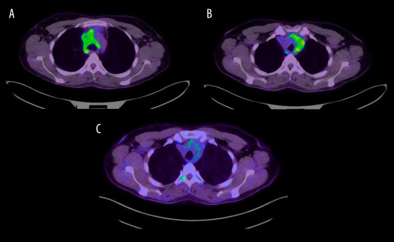 https://cdn.ncbi.nlm.nih.gov/pmc/blobs/7df9/7811979/896907be72e4/amjcaserep-22-e927556-g003.jpg