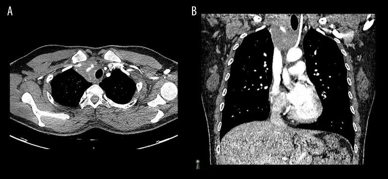 https://cdn.ncbi.nlm.nih.gov/pmc/blobs/7df9/7811979/ddf8f1fd5388/amjcaserep-22-e927556-g001.jpg