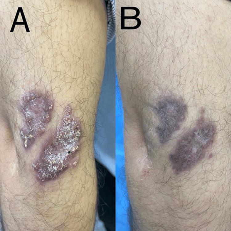 https://cdn.ncbi.nlm.nih.gov/pmc/blobs/7e15/12182216/18951454321f/cureus-0017-00000084618-i04.jpg