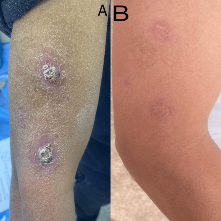 https://cdn.ncbi.nlm.nih.gov/pmc/blobs/7e15/12182216/2c34a13da75a/cureus-0017-00000084618-i05.jpg