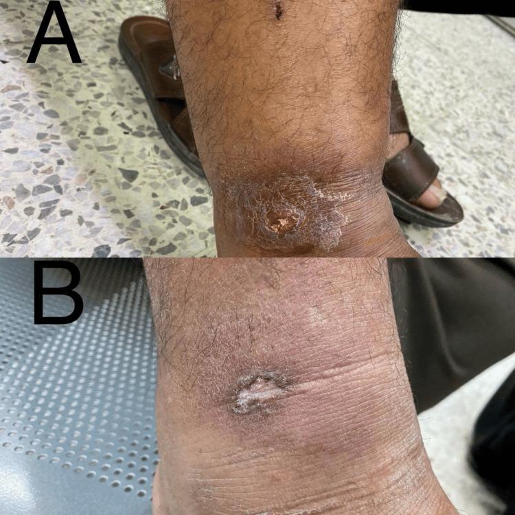 https://cdn.ncbi.nlm.nih.gov/pmc/blobs/7e15/12182216/a54d01f78957/cureus-0017-00000084618-i03.jpg