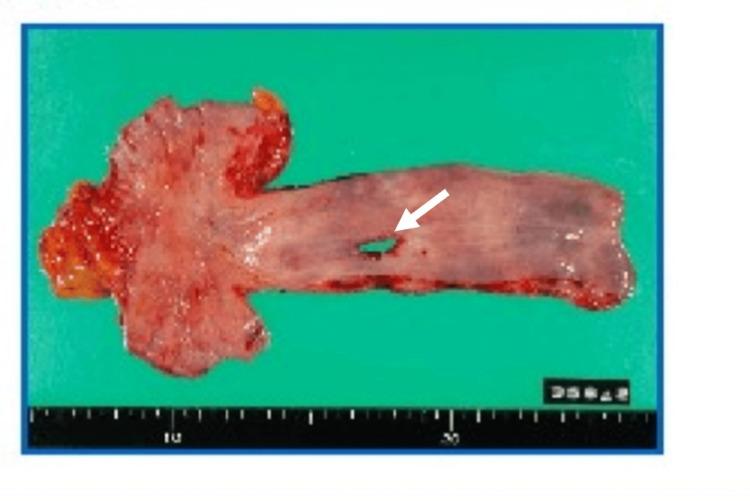https://cdn.ncbi.nlm.nih.gov/pmc/blobs/7e2d/11408958/e09da36f43c2/cureus-0016-00000067169-i05.jpg