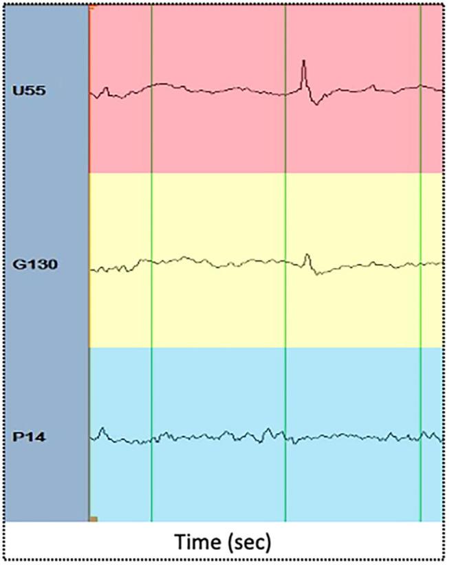 https://cdn.ncbi.nlm.nih.gov/pmc/blobs/7e41/7785800/fce976d5f54f/fneur-11-529460-g0002.jpg