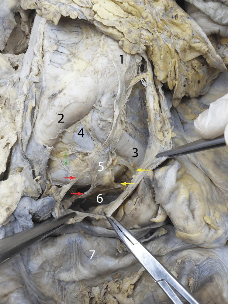https://cdn.ncbi.nlm.nih.gov/pmc/blobs/7e4f/11466058/47cc4931d96d/cureus-0016-00000069091-i02.jpg