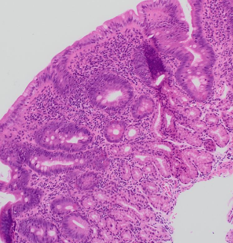 https://cdn.ncbi.nlm.nih.gov/pmc/blobs/7e4f/12079158/768aedfc5097/cureus-0017-00000082221-i06.jpg
