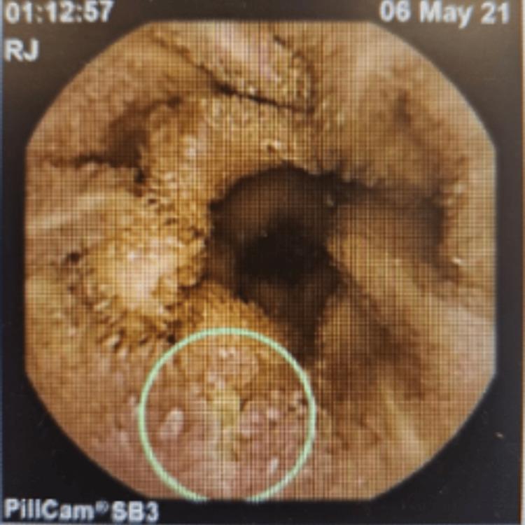 https://cdn.ncbi.nlm.nih.gov/pmc/blobs/7e4f/12079158/979e14429a08/cureus-0017-00000082221-i02.jpg