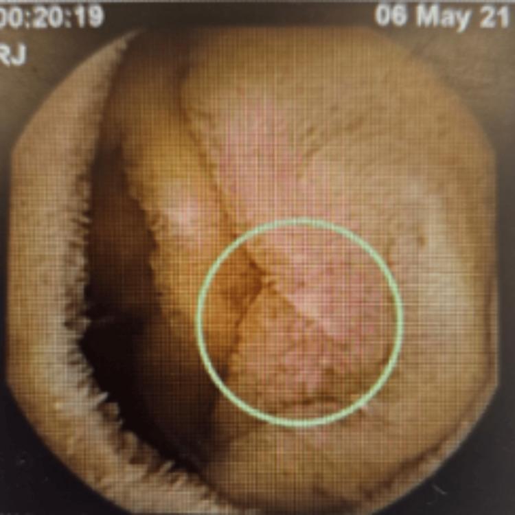 https://cdn.ncbi.nlm.nih.gov/pmc/blobs/7e4f/12079158/a7802f60d0cf/cureus-0017-00000082221-i01.jpg