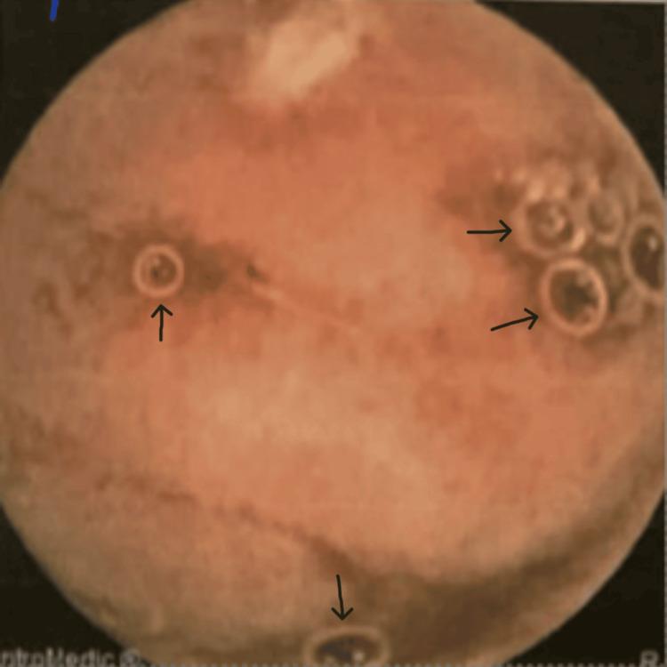 https://cdn.ncbi.nlm.nih.gov/pmc/blobs/7e4f/12079158/e2bace46f9ac/cureus-0017-00000082221-i03.jpg