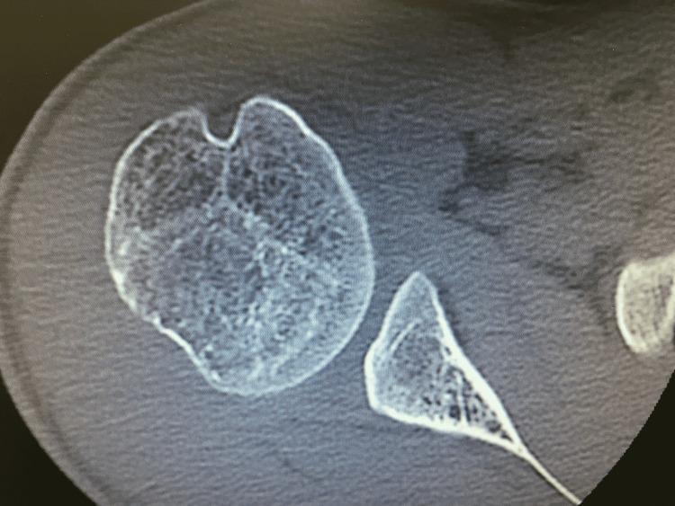 https://cdn.ncbi.nlm.nih.gov/pmc/blobs/7e6b/9117827/2f0e13e2fd06/cureus-0014-00000024198-i03.jpg