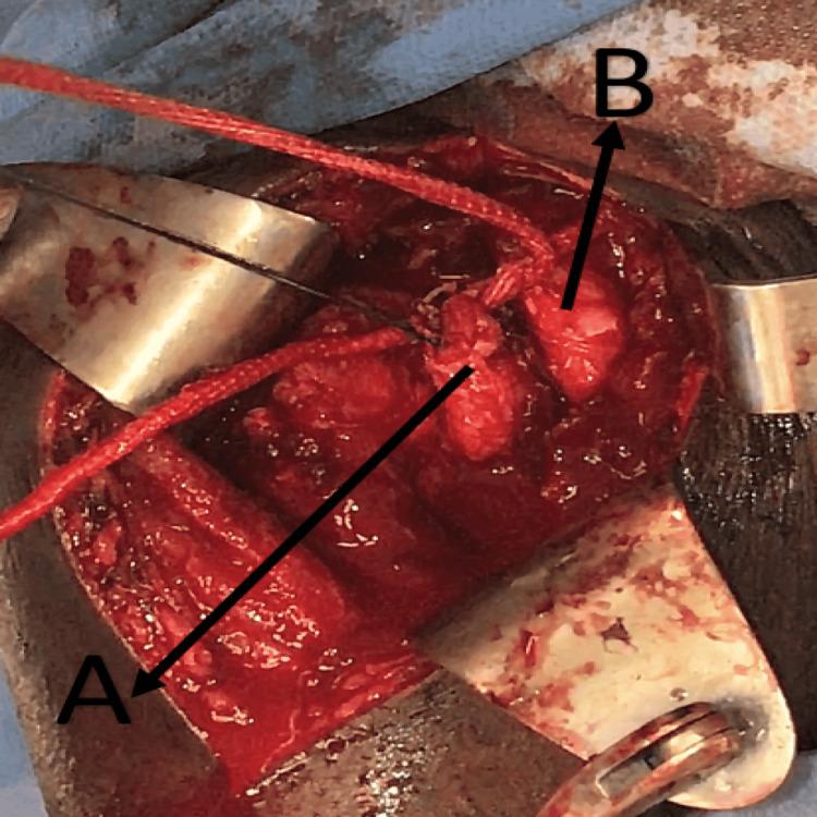 https://cdn.ncbi.nlm.nih.gov/pmc/blobs/7e6b/9117827/7c5fea65b7a1/cureus-0014-00000024198-i07.jpg