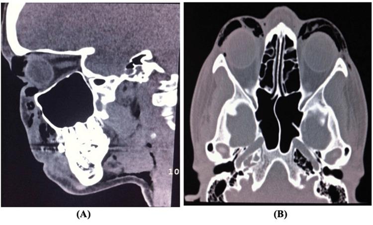https://cdn.ncbi.nlm.nih.gov/pmc/blobs/7e6f/10388289/5e9ce207e44c/cureus-0015-00000041246-i05.jpg
