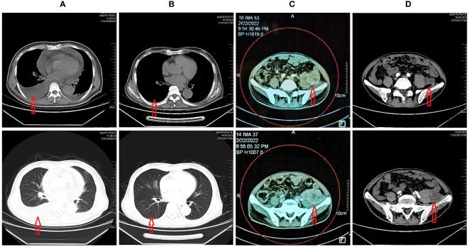 https://cdn.ncbi.nlm.nih.gov/pmc/blobs/7e77/10728639/60b1586055ca/fonc-13-1269735-g001.jpg