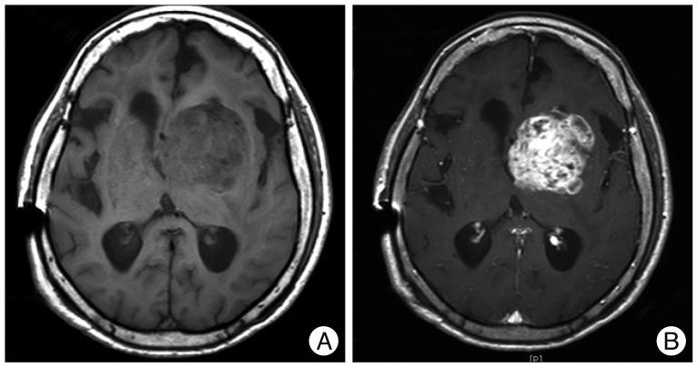 https://cdn.ncbi.nlm.nih.gov/pmc/blobs/7eed/3809438/32577fafc207/jkns-54-125-g002.jpg