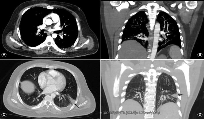 https://cdn.ncbi.nlm.nih.gov/pmc/blobs/7efa/11299070/abeed8437eac/CCR3-12-e9254-g002.jpg
